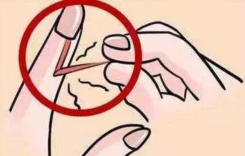 寶寶手指出現倒刺是怎么回事？需要補充維生素嗎？