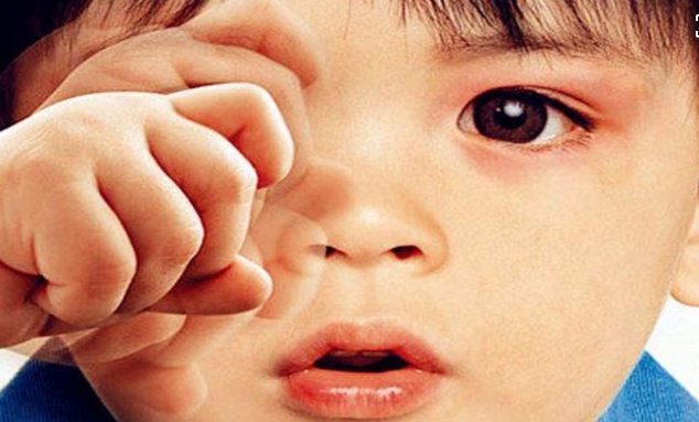 小孩頻繁揉眼，小心兒童過敏性結(jié)膜炎來襲