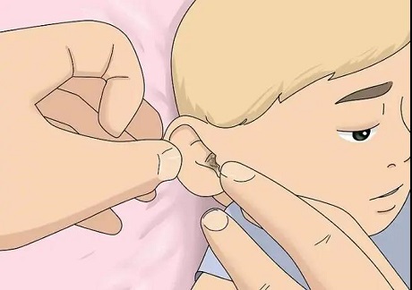 5歲女孩聽力下降，醫(yī)生檢查發(fā)現(xiàn)耳屎堵滿了耳道