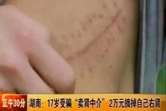 虛榮高中生“賣腎”換蘋果手機，如今人和身體都“廢了”