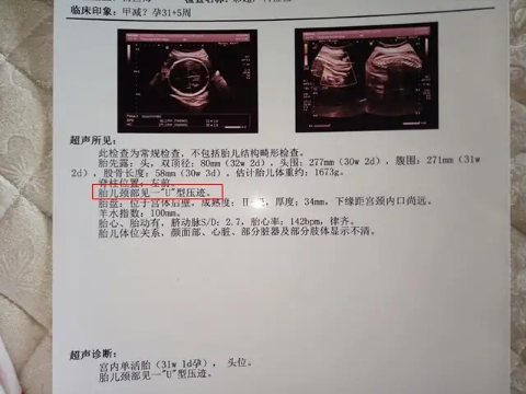孕媽要注意了，你的這些習(xí)慣可能讓胎兒臍帶繞頸