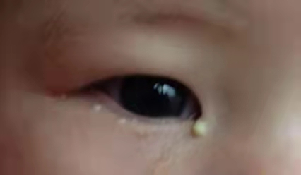 寶寶有眼屎了怎么辦？家長(zhǎng)們不要大意了！