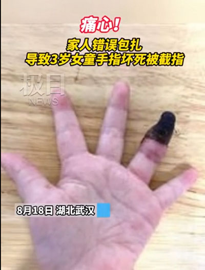 創(chuàng)可貼可別亂用，三歲女童因錯誤包扎手指壞死