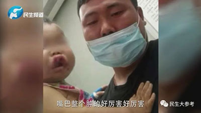 一歲寶寶嘴唇上翻，兩天后被確診白血病