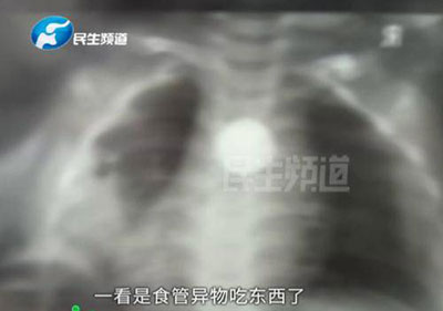 周歲寶寶誤吞異物，導(dǎo)致食道被腐蝕穿孔