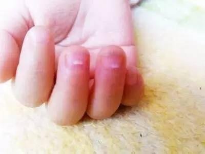 孩子上手的倒刺可能是身體在“求救”，家長千萬要注意