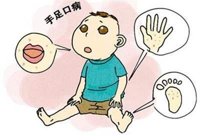 “手足口病”又來了，孩子有這3個癥狀，家長們一定要注意了