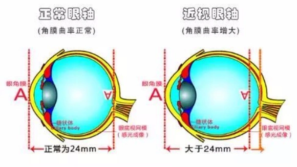 兒童青少年近視防控，“防”的到底是什么？